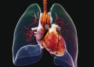 Lung cancers